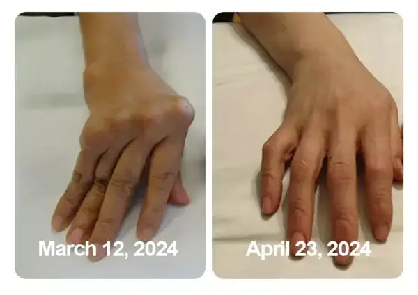 Aeehfeng™ Bee Venom Turmeric Arthritis Treatment Cream 5 Aeehfeng™ Bee Venom Turmeric Arthritis Treatment Cream