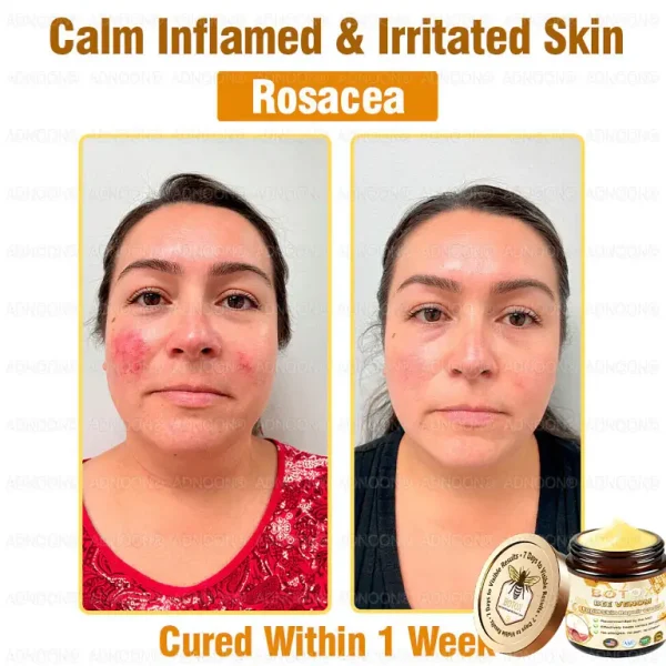 ADNOON™ Botox Skin Treatment Cream