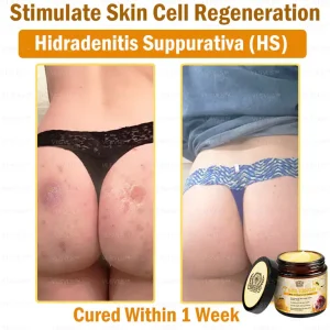 VLSVLS™ Bee Venom skin Anti-bacterial treatment cream