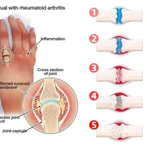 Aeehfeng™ Bee Venom Turmeric Arthritis Treatment Cream 7 Aeehfeng™ Bee Venom Turmeric Arthritis Treatment Cream