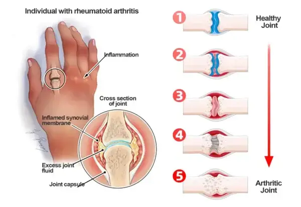 Aeehfeng™ Bee Venom Turmeric Arthritis Treatment Cream 3 Aeehfeng™ Bee Venom Turmeric Arthritis Treatment Cream