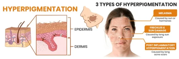 Fast Dark Spot Remover-KISSHI™ Melanin Correcting Facial Serum