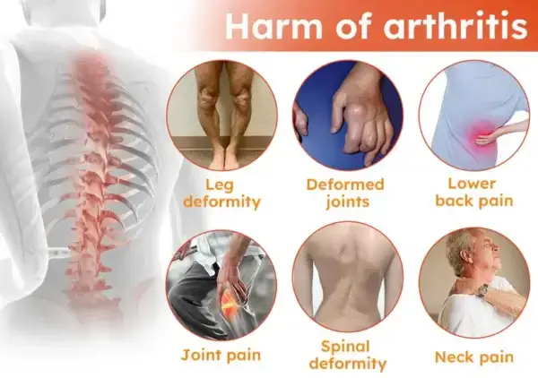 Aeehfeng™ Bee Venom Turmeric Arthritis Treatment Cream 4 Aeehfeng™ Bee Venom Turmeric Arthritis Treatment Cream