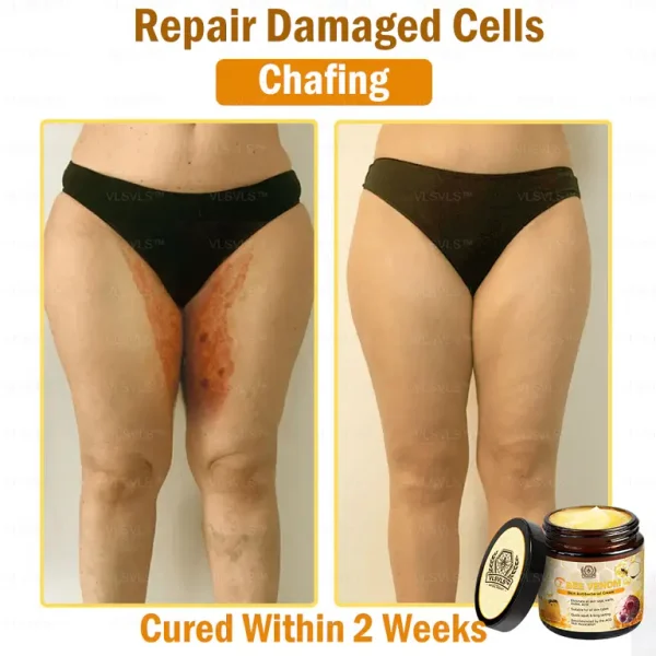 VLSVLS™ Bee Venom skin Anti-bacterial treatment cream