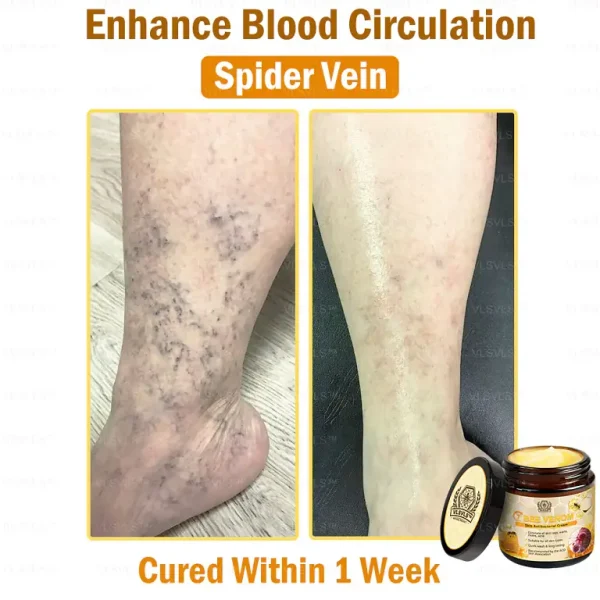VLSVLS™ Bee Venom skin Anti-bacterial treatment cream