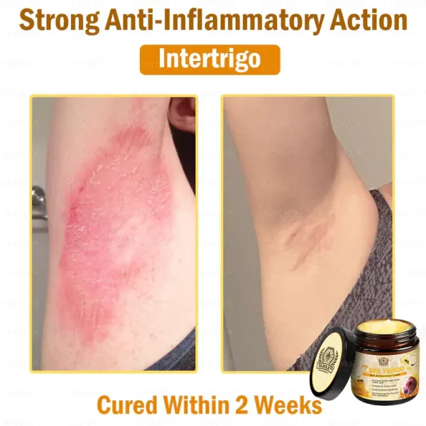 VLSVLS™ Bee Venom skin Anti-bacterial treatment cream