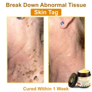 👨‍⚕️Mayo Clinic Official: Furzero™ Botox Skin Treatment Cream Anti-aging, Hydrating, Skin Repair, Even Tone, Acne and Dark Spot Treatment, Wart and Mole Removal, Psoriasis Relief