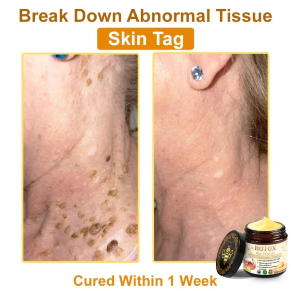 👨‍⚕️Mayo Clinic Official: Furzero™ Botox Skin Treatment Cream Anti-aging, Hydrating, Skin Repair, Even Tone, Acne and Dark Spot Treatment, Wart and Mole Removal, Psoriasis Relief