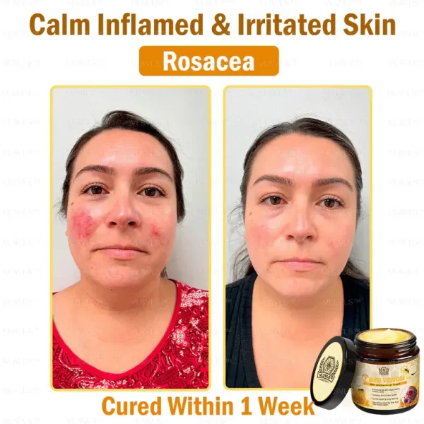 VLSVLS™ Bee Venom skin Anti-bacterial treatment cream