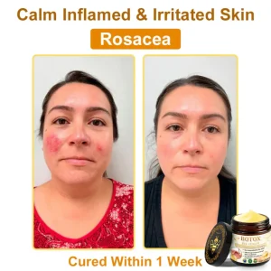 👨‍⚕️Mayo Clinic Official: Furzero™ Botox Skin Treatment Cream Anti-aging, Hydrating, Skin Repair, Even Tone, Acne and Dark Spot Treatment, Wart and Mole Removal, Psoriasis Relief
