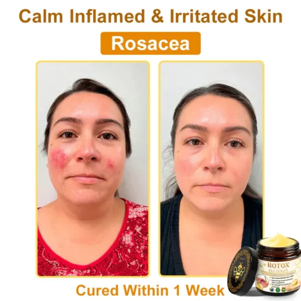 👨‍⚕️Mayo Clinic Official: Furzero™ Botox Skin Treatment Cream Anti-aging, Hydrating, Skin Repair, Even Tone, Acne and Dark Spot Treatment, Wart and Mole Removal, Psoriasis Relief