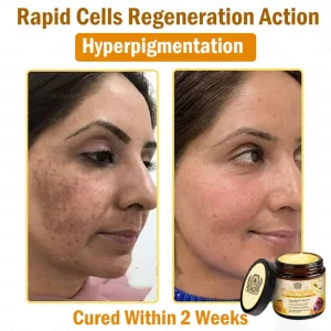 VLSVLS™ Bee Venom skin Anti-bacterial treatment cream