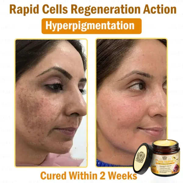 VLSVLS™ Bee Venom skin Anti-bacterial treatment cream