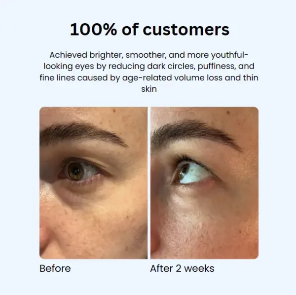 Microneedle Eye Patches