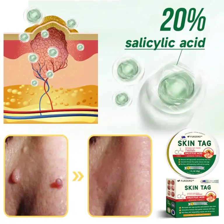 Furzero™ 20% Salicylic Acid Skin Treatment Cream Dermatologist-Approved Safe & Fast-Acting Formula Helps with Warts, Psoriasis, Eczema, and More 10 Furzero™ 20% Salicylic Acid Skin Treatment Cream ✔️ Dermatologist-Approved ✔️ Safe & Fast-Acting Formula✔️ Helps with Warts, Psoriasis, Eczema, and More