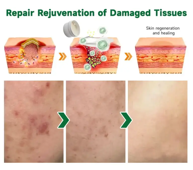 Furzero™ 20% Salicylic Acid Skin Treatment Cream Dermatologist-Approved Safe & Fast-Acting Formula Helps with Warts, Psoriasis, Eczema, and More 11 Furzero™ 20% Salicylic Acid Skin Treatment Cream ✔️ Dermatologist-Approved ✔️ Safe & Fast-Acting Formula✔️ Helps with Warts, Psoriasis, Eczema, and More