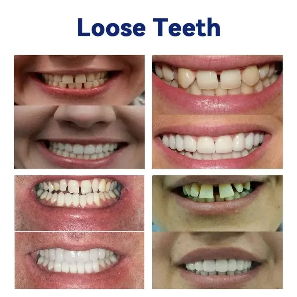 SmileFitPro New Generation Flexible Full Denture Solution