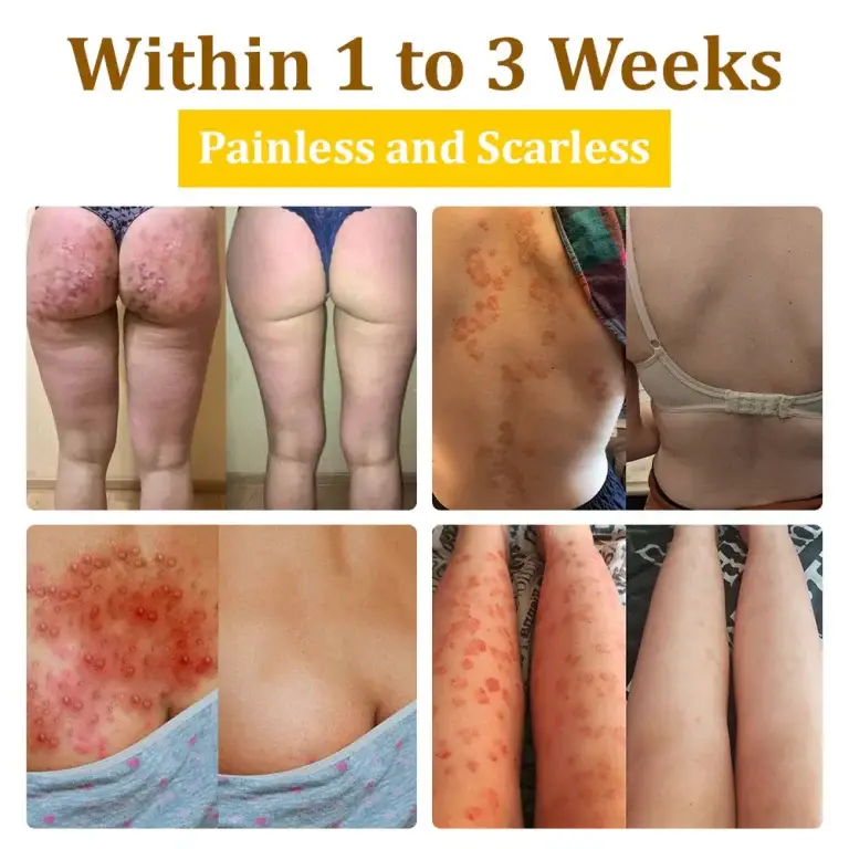 Furzero™ 20% Salicylic Acid Skin Treatment Cream Dermatologist-Approved Safe & Fast-Acting Formula Helps with Warts, Psoriasis, Eczema, and More 6 Furzero™ 20% Salicylic Acid Skin Treatment Cream ✔️ Dermatologist-Approved ✔️ Safe & Fast-Acting Formula✔️ Helps with Warts, Psoriasis, Eczema, and More
