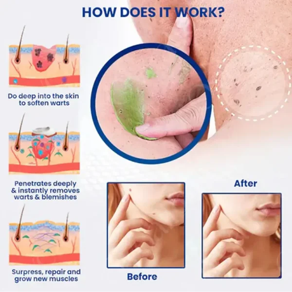 Oveallgo® NatureErase Plus Instant Mole & Spot Removal Gel