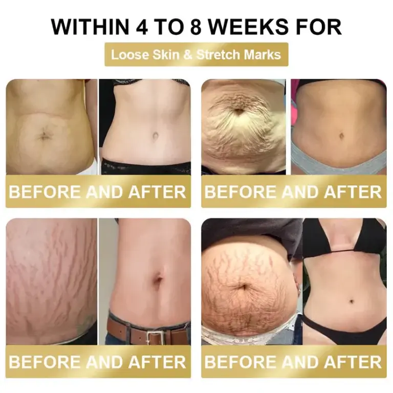 Lovilds Bee Venom Lymphatic Drainage Slimming Patch (Suitable for use by individuals of all ages) 6 Lovilds Bee Venom Lymphatic Drainage Slimming Patch (Suitable for use by individuals of all ages)