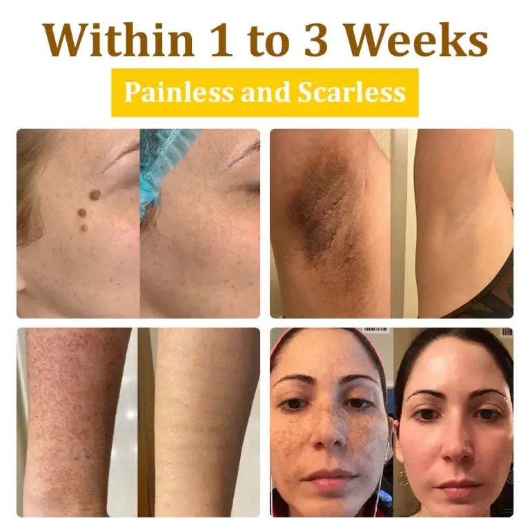Furzero™ 20% Salicylic Acid Skin Treatment Cream Dermatologist-Approved Safe & Fast-Acting Formula Helps with Warts, Psoriasis, Eczema, and More 2 Furzero™ 20% Salicylic Acid Skin Treatment Cream ✔️ Dermatologist-Approved ✔️ Safe & Fast-Acting Formula✔️ Helps with Warts, Psoriasis, Eczema, and More