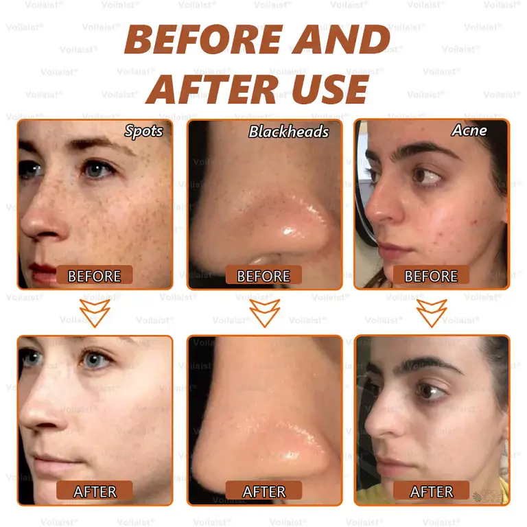 Voilaist® Whitening and Spot-Removing Face Mask Suitable for face and body – Natural ingredients permanently remove age spots, freckles, sun spots, and liver spots. 2 Voilaist® Whitening and Spot-Removing Face Mask Suitable for face and body – Natural ingredients permanently remove age spots, freckles, sun spots, and liver spots.