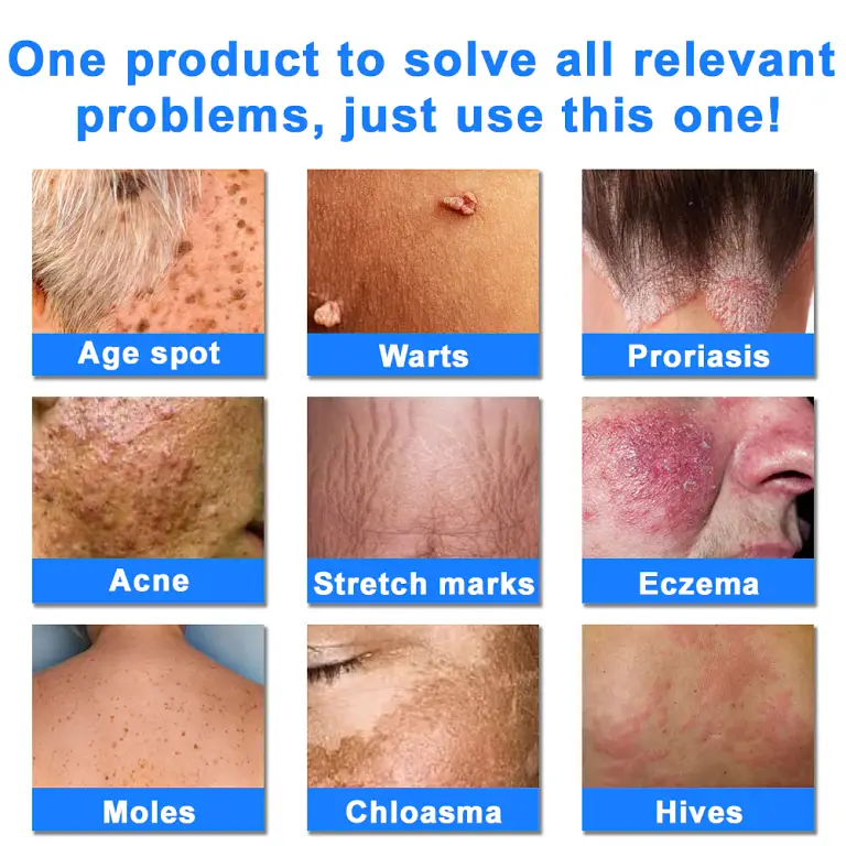 Ourlyard® Skin Treatment Cream 8 Ourlyard® Skin Treatment Cream