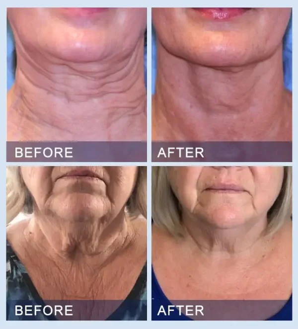 Big Savings Furzero™ All-in-One Lifting & Firming Serum