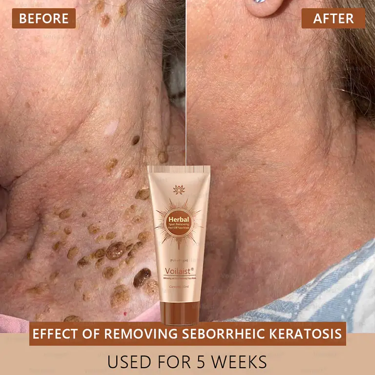 Voilaist® Whitening and Spot-Removing Face Mask Suitable for face and body – Natural ingredients permanently remove age spots, freckles, sun spots, and liver spots. 6 Voilaist® Whitening and Spot-Removing Face Mask Suitable for face and body – Natural ingredients permanently remove age spots, freckles, sun spots, and liver spots.