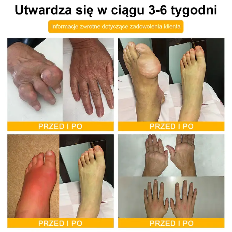 TLOPA® Botulinum Toxin and Bee Venom Pain Relief Balm and Bone Healing 12 TLOPA® Botulinum Toxin and Bee Venom Pain Relief Balm and Bone Healing