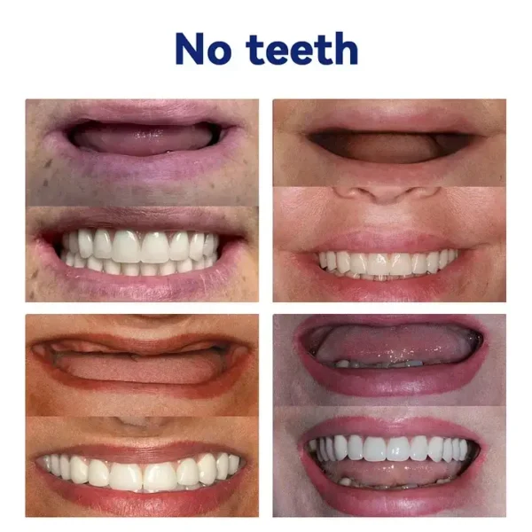 SmileFitPro New Generation Flexible Full Denture Solution