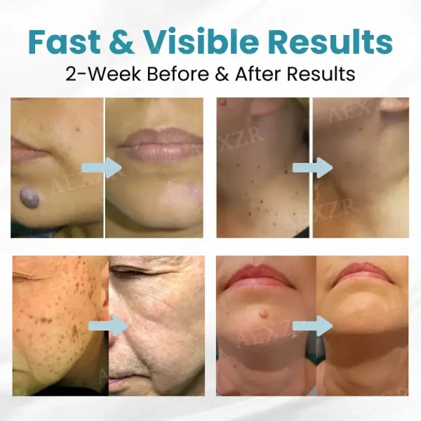 Nurbini® Non-Invasive Mole and Wart Removal Laser Pen