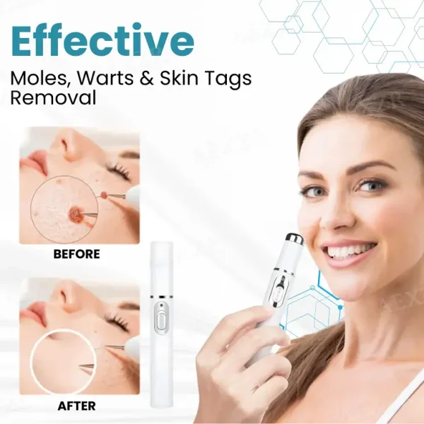 Nurbini® Non-Invasive Mole and Wart Removal Laser Pen