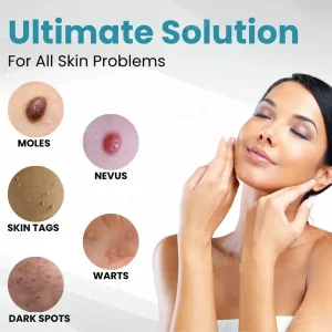 Nurbini® Non-Invasive Mole and Wart Removal Laser Pen