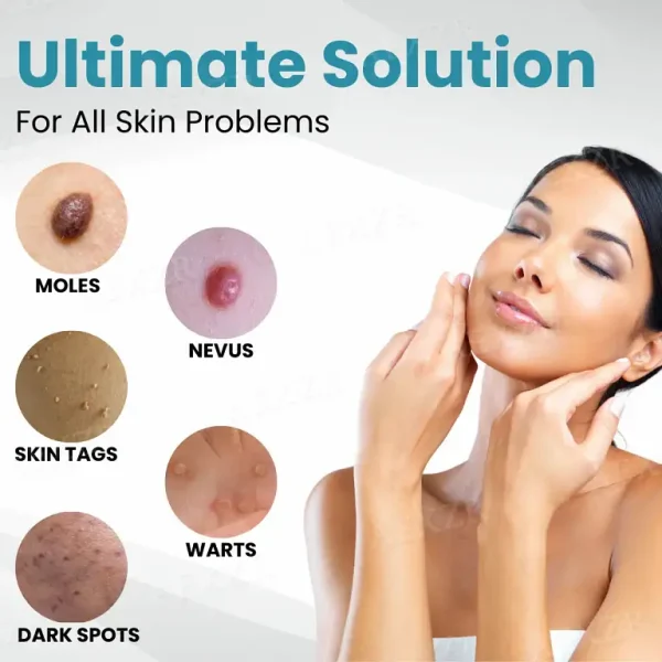 Nurbini® Non-Invasive Mole and Wart Removal Laser Pen