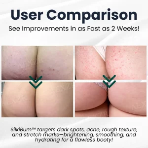 SilkiBum™ Butt Skin Care Cream