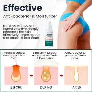 SilkiBum™ Butt Skin Care Cream
