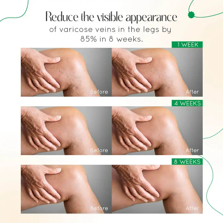 LOVILDS™ Vein Therapy Cream 5 LOVILDS™ Vein Therapy Cream