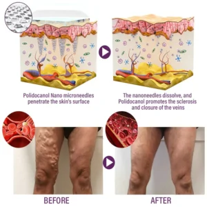 Timilk® Polidocanol Nano Varicose Vein Patch