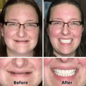 SmileFitPro™-Advanced Custom-Fit Functional Dentures