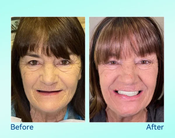 𝐁𝐢𝐤𝐞𝐧𝐝𝐚®👩‍⚕️🎁𝐏𝐫𝐞𝐦𝐢𝐮𝐦 𝐅𝐮𝐥𝐥 𝐒𝐞𝐭 𝐃𝐞𝐧𝐭𝐮𝐫𝐞𝐬 – 𝐍𝐚𝐭𝐮𝐫𝐚𝐥 𝐂𝐨𝐦𝐟𝐨𝐫𝐭, 𝐔𝐧𝐛𝐞𝐚𝐭𝐚𝐛𝐥𝐞 𝐅𝐢𝐭(🦷𝐋𝐢𝐦𝐢𝐭𝐞𝐝 𝐭𝐢𝐦𝐞 𝐝𝐢𝐬𝐜𝐨𝐮𝐧𝐭 𝐋𝐚𝐬𝐭 𝟑𝟎 𝐦𝐢𝐧𝐮𝐭𝐞𝐬🦷)