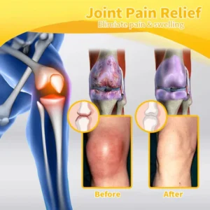 Flysmus® Bee Venom Pain-Relief Bone Healing Cream