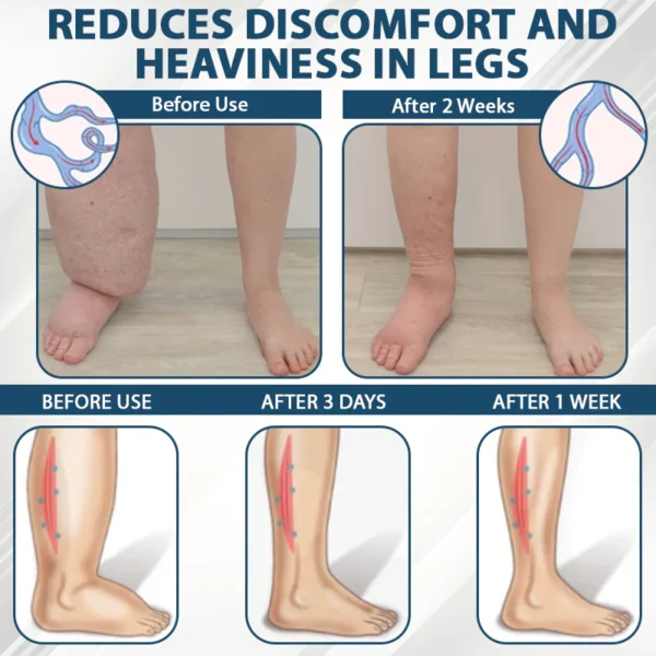 ATTDX® CuminBee Edema Relief Herbal Cream