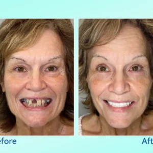 𝐁𝐢𝐤𝐞𝐧𝐝𝐚®👩‍⚕️🎁𝐏𝐫𝐞𝐦𝐢𝐮𝐦 𝐅𝐮𝐥𝐥 𝐒𝐞𝐭 𝐃𝐞𝐧𝐭𝐮𝐫𝐞𝐬 – 𝐍𝐚𝐭𝐮𝐫𝐚𝐥 𝐂𝐨𝐦𝐟𝐨𝐫𝐭, 𝐔𝐧𝐛𝐞𝐚𝐭𝐚𝐛𝐥𝐞 𝐅𝐢𝐭(🦷𝐋𝐢𝐦𝐢𝐭𝐞𝐝 𝐭𝐢𝐦𝐞 𝐝𝐢𝐬𝐜𝐨𝐮𝐧𝐭 𝐋𝐚𝐬𝐭 𝟑𝟎 𝐦𝐢𝐧𝐮𝐭𝐞𝐬🦷)